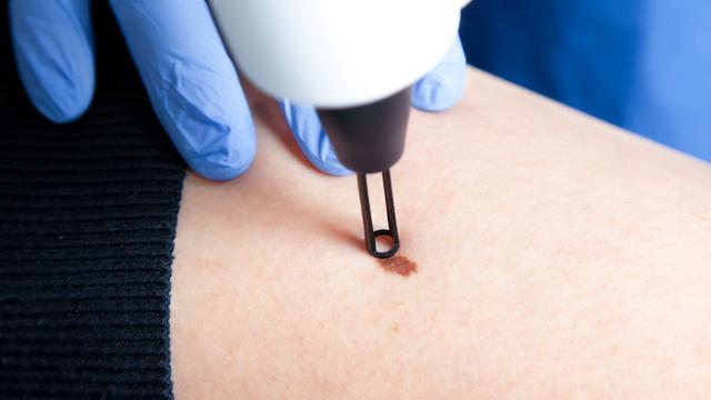 Muttermal selber entfernen oder zum Hautarzt gehen? Vor- und Nachteile abwägen Muttermal selber entfernen oder zum Hautarzt gehen? Vor- und Nachteile abwägen