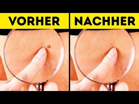 Muttermal entfernen: Tipps zur Selbstbehandlung mit Apfelessig Muttermal entfernen: Tipps zur Selbstbehandlung mit Apfelessig