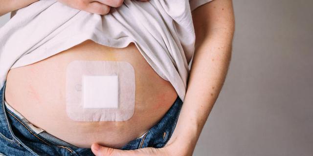 Nabelbruch erkennen: Was Sie selbst tun können Nabelbruch erkennen: Was Sie selbst tun können