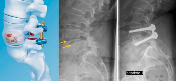 Nach einer Operation zur Versteifung der Lendenwirbelsäule: Richtlinien für die Genesungsphase Nach einer Operation zur Versteifung der Lendenwirbelsäule: Richtlinien für die Genesungsphase
