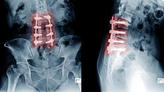 Nach einer Wirbelsäulenversteifung: Was darf man in der postoperativen Phase tun? Nach einer Wirbelsäulenversteifung: Was darf man in der postoperativen Phase tun?