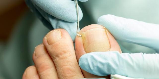 Nagelbettentzündung und Blutvergiftung: Selten, aber möglich