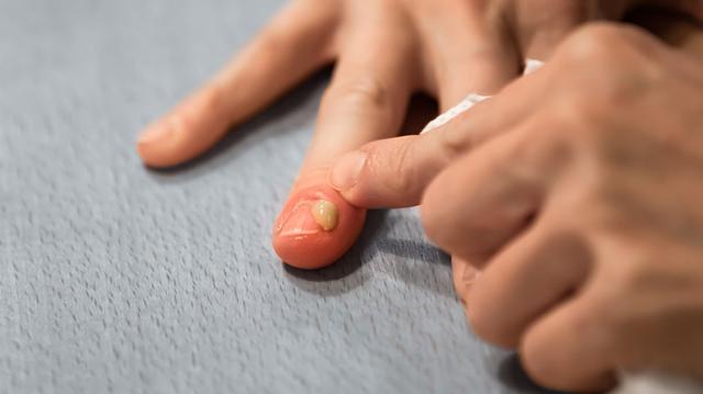 Nagelbettentzündung? Tipps zur Behandlung - Sieu Thi Do Noi That