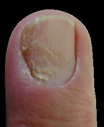 Komplikationen bei Nagelbettentzündungen: Risiken und Prävention