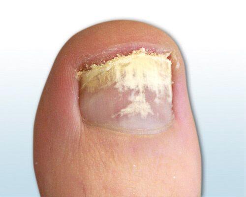 3. Verfärbte und bröckelige Nägel - kein Nagelpilz, sondern etwas anderes? 3. Verfärbte und bröckelige Nägel - kein Nagelpilz, sondern etwas anderes?