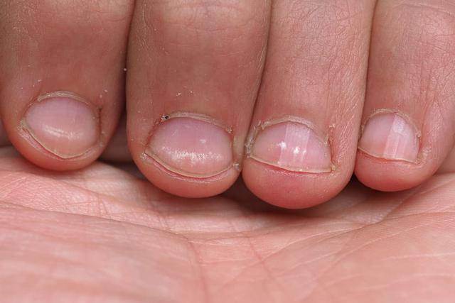 4. Wenn es wie Nagelpilz aussieht, aber keiner ist: Mögliche Ursachen für veränderte Nägel 4. Wenn es wie Nagelpilz aussieht, aber keiner ist: Mögliche Ursachen für veränderte Nägel