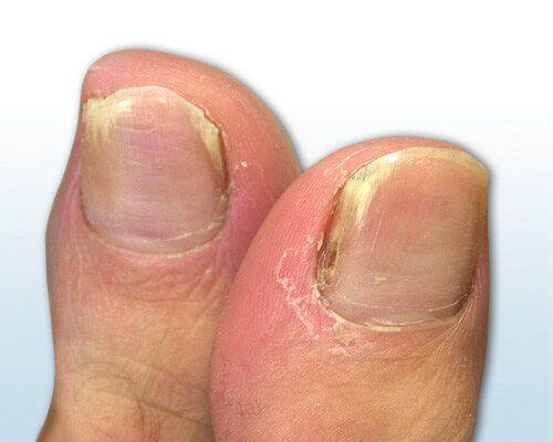 6. Falscher Alarm: Symptome ähneln Nagelpilz, sind aber keine Pilzinfektion 6. Falscher Alarm: Symptome ähneln Nagelpilz, sind aber keine Pilzinfektion