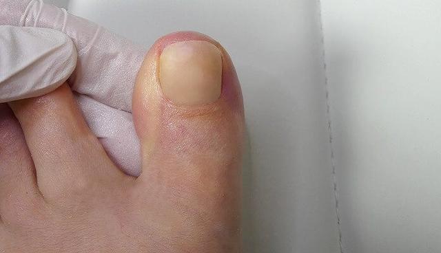 Selbstgemachte Nagelprothetik: Eine einfache Anleitung Selbstgemachte Nagelprothetik: Eine einfache Anleitung