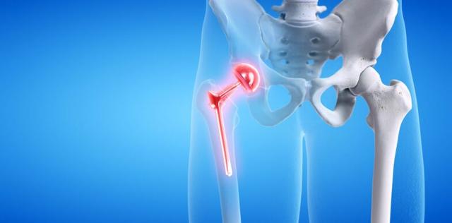 Behandlungsmöglichkeiten für Nervenschädigungen nach einer Hüftoperation Behandlungsmöglichkeiten für Nervenschädigungen nach einer Hüftoperation