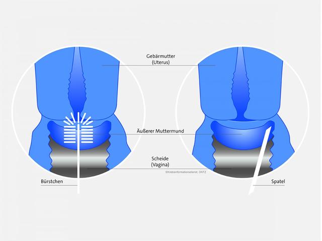 Jüngere Frauen haben ein höheres Risiko, sich mit HPV zu infizieren