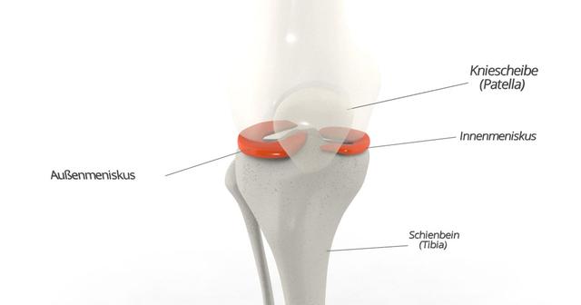 Dauer der Schmerzen nach Meniskusoperation: Was ist normal? Dauer der Schmerzen nach Meniskusoperation: Was ist normal?
