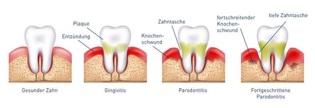 Unterschied zwischen Parodontitis und Gingivitis: Was Sie wissen sollten Unterschied zwischen Parodontitis und Gingivitis: Was Sie wissen sollten
