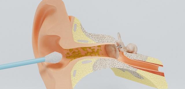 Ohrenschmalz selbst entfernen - Tipps und Tricks Ohrenschmalz selbst entfernen - Tipps und Tricks