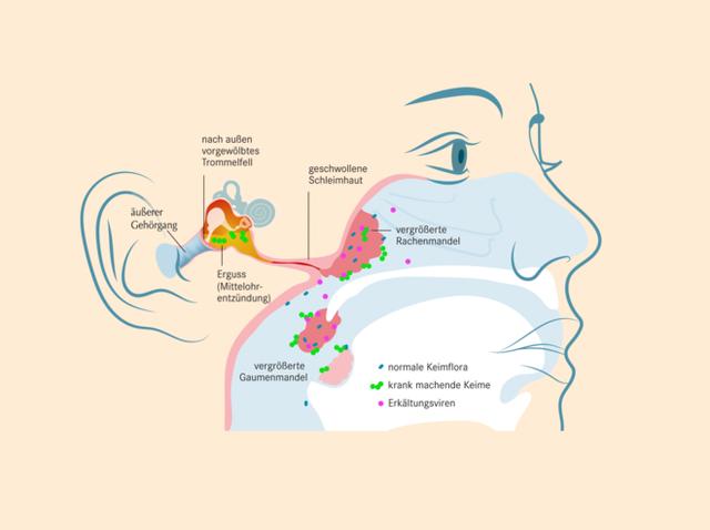 Ohrenschmerzen rechts: Ursachen und Bedeutung Ohrenschmerzen rechts: Ursachen und Bedeutung