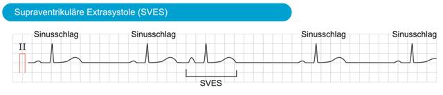 Die Bedeutung von Sves EKG einfach erklärt Die Bedeutung von Sves EKG einfach erklärt