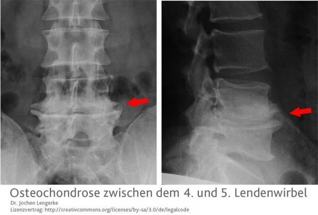 Osteochondrose verstehen und behandeln: Informationen und Tipps