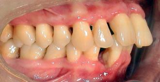Unsichtbare Zahnspange (Invisalign) bei Parodontose: Eine Alternative zur herkömmlichen Behandlung? Unsichtbare Zahnspange (Invisalign) bei Parodontose: Eine Alternative zur herkömmlichen Behandlung?