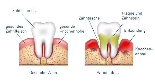 Parodontose: Unterschiede zur Parodontitis und wie man vorbeugen kann Parodontose: Unterschiede zur Parodontitis und wie man vorbeugen kann