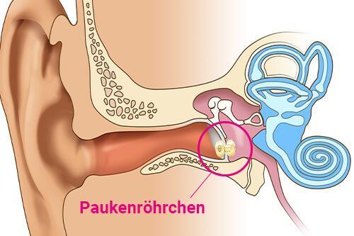 Wann ist eine Operation bei einem Paukenerguss notwendig?