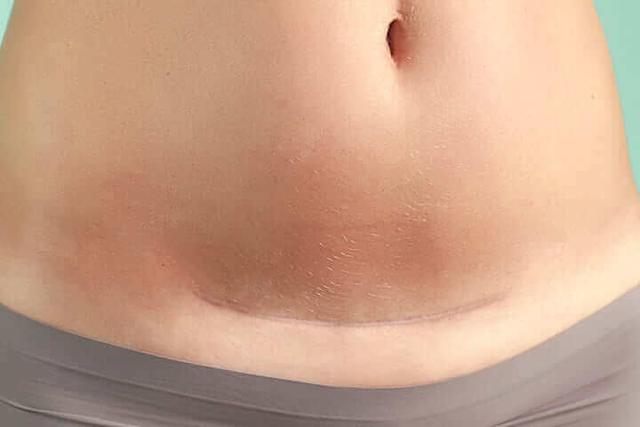 Periode nach Kaiserschnitt: Wann kann man sie erwarten?