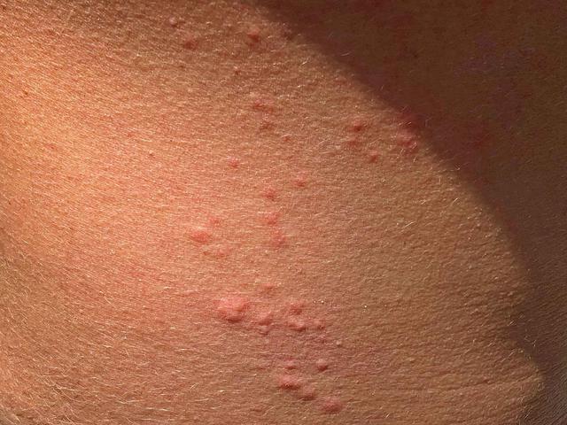 Hautempfindlichkeit: Warum fühlt es sich an wie Nadelstiche? Hautempfindlichkeit: Warum fühlt es sich an wie Nadelstiche?