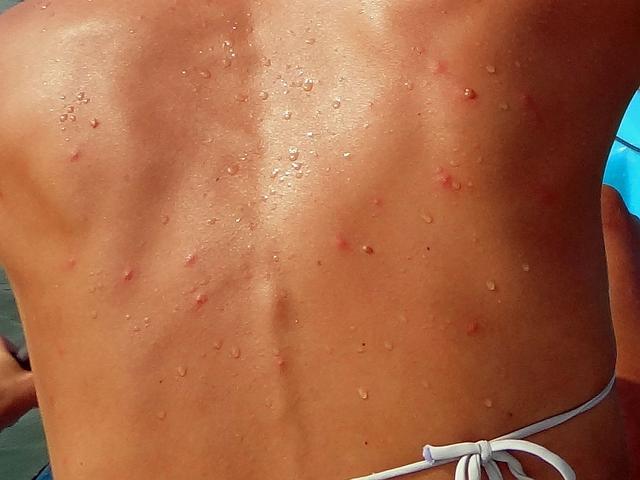 Hautreaktionen: Nadelstiche ähnliches Pieksen auf der Haut Hautreaktionen: Nadelstiche ähnliches Pieksen auf der Haut