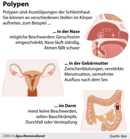 Polypen im Körper: Was Sie wissen sollten Polypen im Körper: Was Sie wissen sollten