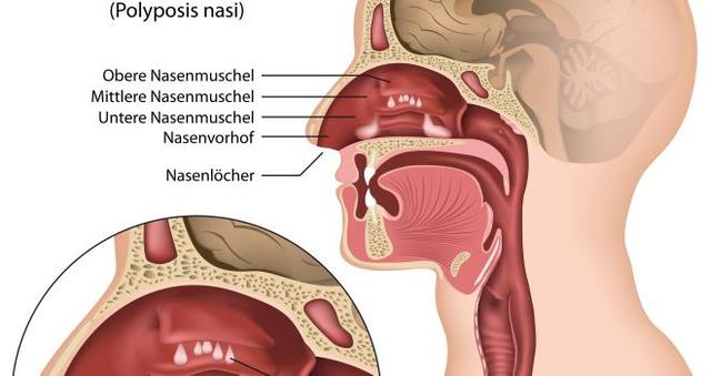Polypen: Definition, Formen und Untersuchungsmethoden Polypen: Definition, Formen und Untersuchungsmethoden