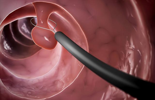 Polypen: Symptome, Diagnose und Behandlungsmöglichkeiten Polypen: Symptome, Diagnose und Behandlungsmöglichkeiten