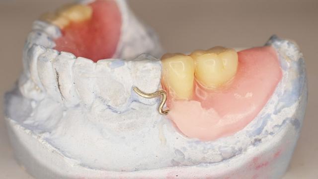 DIY-Prothesenunterfütterung: Risiken und Vorteile im Überblick DIY-Prothesenunterfütterung: Risiken und Vorteile im Überblick
