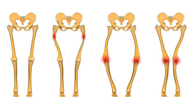 Rachitis: Ursachen, Symptome und Behandlungsmöglichkeiten Rachitis: Ursachen, Symptome und Behandlungsmöglichkeiten