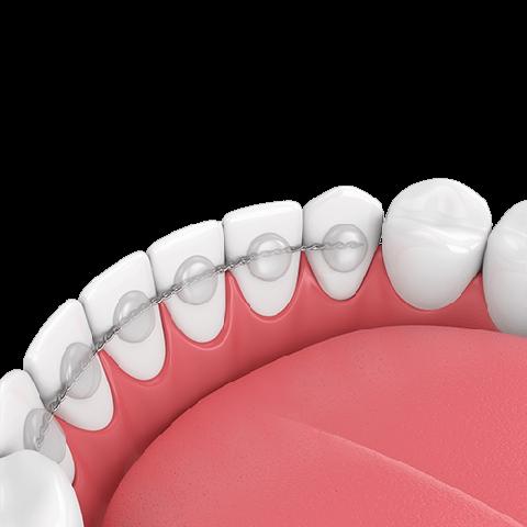 4. "Feste und herausnehmbare Retainer im Vergleich" 4. "Feste und herausnehmbare Retainer im Vergleich"