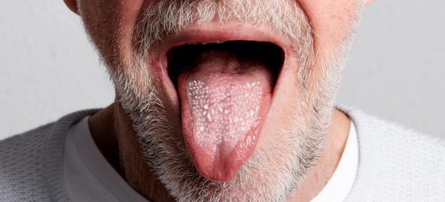 Mundpilz durch Cortisonspray: Praktische Lösungen und Empfehlungen Mundpilz durch Cortisonspray: Praktische Lösungen und Empfehlungen