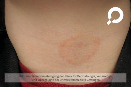 Ringelflechte: Wie lange bleibt sie ansteckend? Ringelflechte: Wie lange bleibt sie ansteckend?