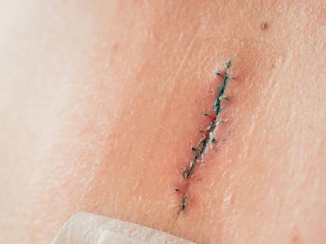 Behandlungsmöglichkeiten bei aufgegangener OP-Naht: Was Sie wissen sollten Behandlungsmöglichkeiten bei aufgegangener OP-Naht: Was Sie wissen sollten