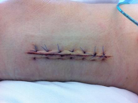 Wie reagieren, wenn die Naht nach der Operation aufgegangen ist? Wie reagieren, wenn die Naht nach der Operation aufgegangen ist?