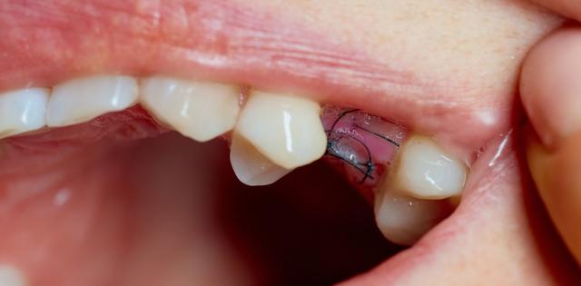 Was tun, wenn die OP-Naht aufgegangen ist? Tipps zur Behandlung von Wunddehiszenz Was tun, wenn die OP-Naht aufgegangen ist? Tipps zur Behandlung von Wunddehiszenz