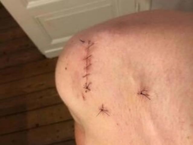 Wunddehiszenz: Maßnahmen und Vorgehensweise bei geöffneter OP-Naht Wunddehiszenz: Maßnahmen und Vorgehensweise bei geöffneter OP-Naht