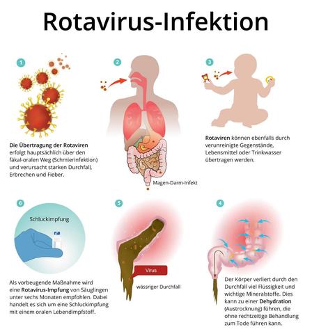 Rotaviren-Infektionen: Häufigkeit und Verlauf Rotaviren-Infektionen: Häufigkeit und Verlauf