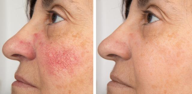 Hausmittel und Methoden zur Entfernung von geplatzten Äderchen im Gesicht Hausmittel und Methoden zur Entfernung von geplatzten Äderchen im Gesicht