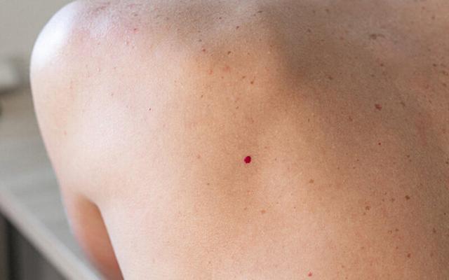 Rubinflecken auf der Haut: Ursachen, Symptome und Behandlung Rubinflecken auf der Haut: Ursachen, Symptome und Behandlung