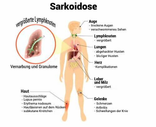 Sarkoidose: Aussichten auf Heilung und Prävalenz in verschiedenen Regionen Sarkoidose: Aussichten auf Heilung und Prävalenz in verschiedenen Regionen