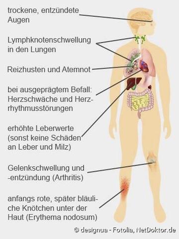 Überblick über Sarkoidose: Symptome, Ursachen und Behandlung Überblick über Sarkoidose: Symptome, Ursachen und Behandlung