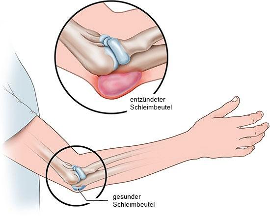 Geplatzter Schleimbeutel am Ellenbogen: Sofortige Hilfe und langfristige Behandlungsoptionen