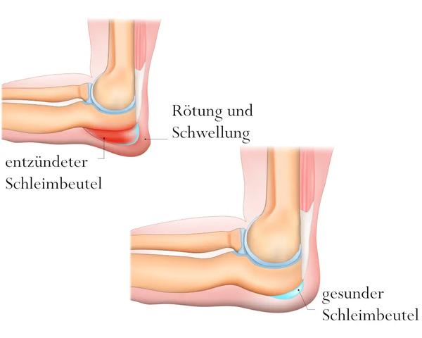 Notfall Schleimbeutelriss am Ellenbogen: Wie Sie richtig handeln