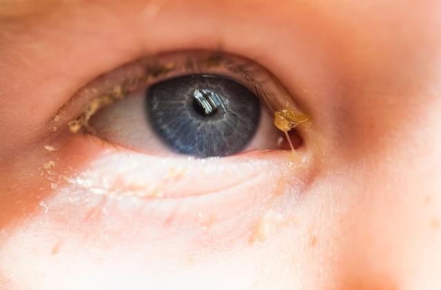 Schleimfäden im Auge: Ursachen und Behandlungsmöglichkeiten Schleimfäden im Auge: Ursachen und Behandlungsmöglichkeiten