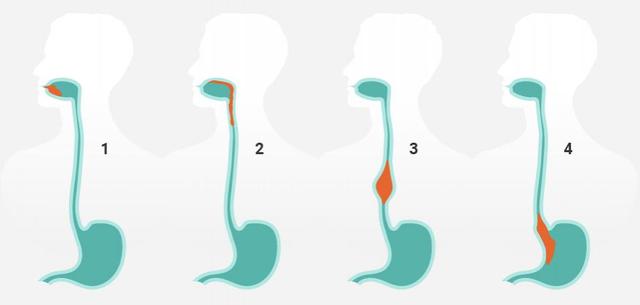Was tun bei Schluckbeschwerden? Hilfreiche Maßnahmen im Überblick Was tun bei Schluckbeschwerden? Hilfreiche Maßnahmen im Überblick