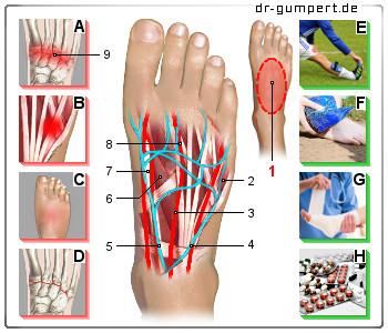 Optimale Anpassung des Schuhwerks bei Schmerzen auf dem Spann Optimale Anpassung des Schuhwerks bei Schmerzen auf dem Spann