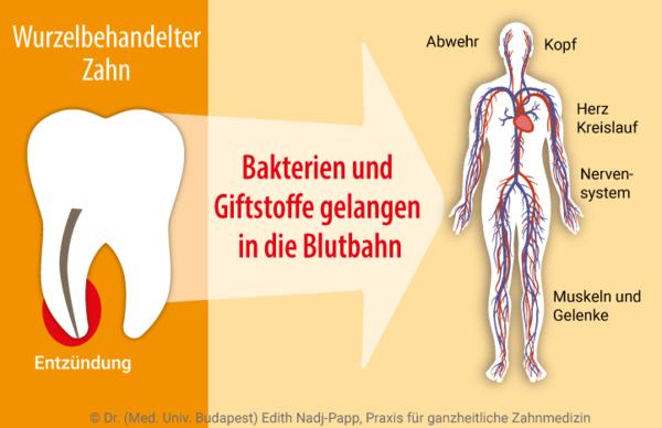 Nach Jahren noch Schmerzen an einem wurzelbehandelten Zahn: Wie kann geholfen werden? Nach Jahren noch Schmerzen an einem wurzelbehandelten Zahn: Wie kann geholfen werden?