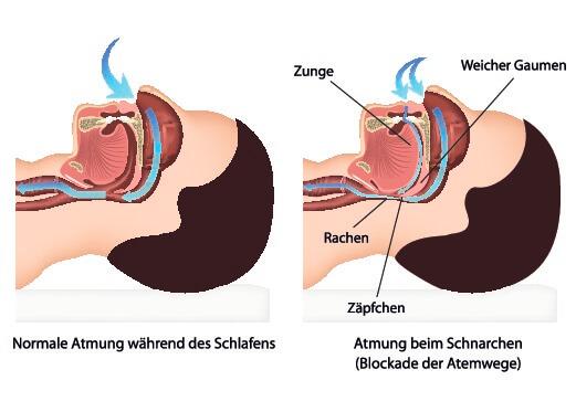 Ruhige Nächte ohne Schnarchgeräusche: Sofort wirksame Tipps und Tricks Ruhige Nächte ohne Schnarchgeräusche: Sofort wirksame Tipps und Tricks